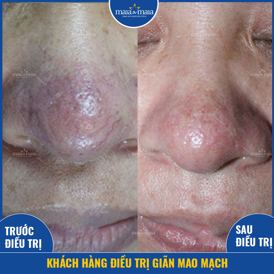 Kết quả giãn mao mạch bằng công nghệ Hyperion