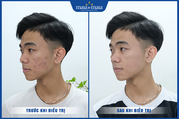 khách bắn laser trị mụn trứng cá