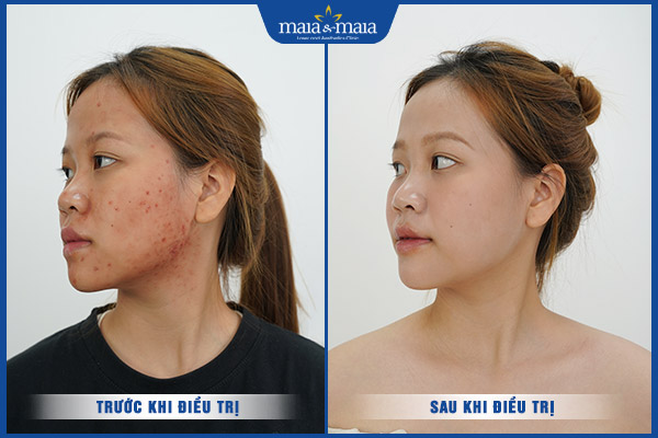 khách hàng điều trị mụn bằng laser