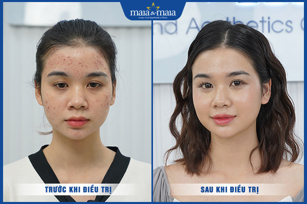 khách hàng bắn laser diot