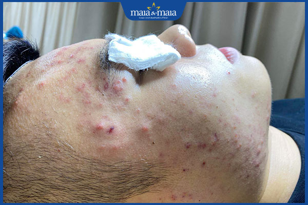 Hỗ trợ điều trị mụn trứng cá bằng công nghệ Laser Diot 4 mụn trứng cá xung quanh mặt