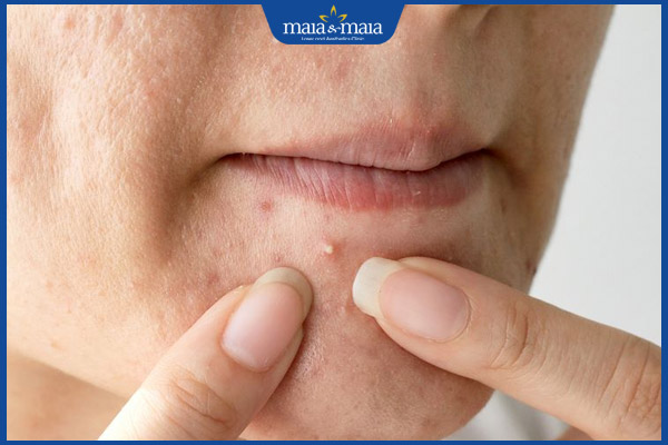 Những sai lầm khi điều trị mụn trứng cá 2 tự ý nặn mụn