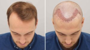 FUE Hair Transplantation
