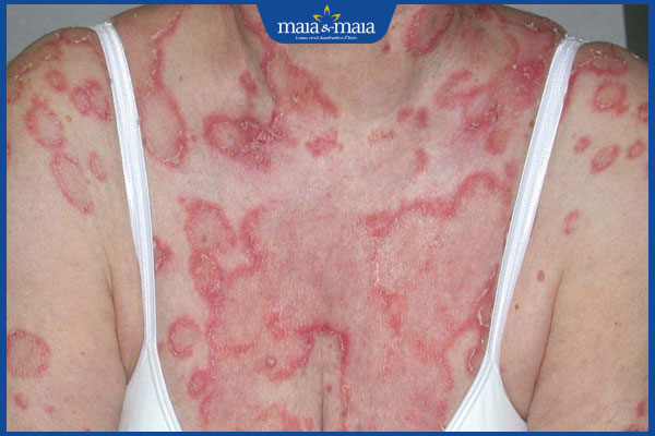 bị lupus ban đỏ