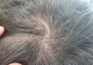 Mối liên hệ giữa viêm da tiết bã và rụng tóc 3 Viêm da tiết bã thường kèm các mảng da đỏ