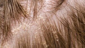 Mối liên hệ giữa viêm da tiết bã và rụng tóc 4 Tình trạng viêm da nhẹ trên da đầu có thể khỏi nhờ dầu gội đặc trị