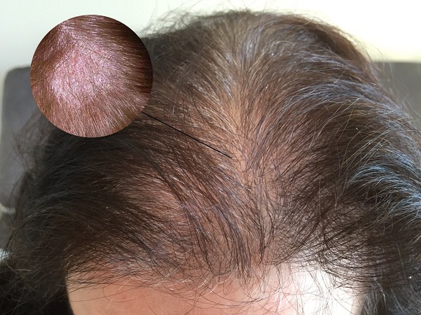 Các bệnh da đầu thường gặp và cách điều trị 5 Nấm đầu là một bệnh da đầu phổ biến và là một trong những nguyên nhân gây rụng tóc