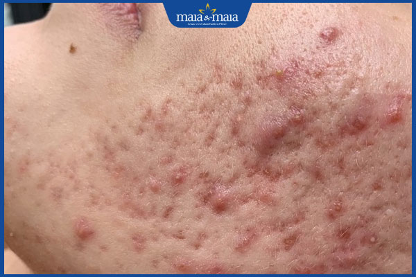 nguyên nhân gây ra sẹo rỗ đáy nhọn
