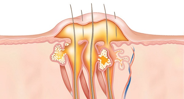 Điều trị viêm nang lông da đầu để ngăn rụng tóc 4 Các ổ viêm thông với nhau, tạo thành tương tổn ở sâu trong nang tóc