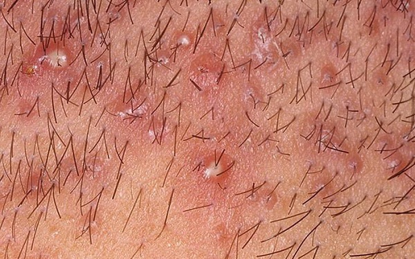 Điều trị viêm nang lông da đầu để ngăn rụng tóc 5 Mụn viêm nang lông da đầu kèm theo mủ
