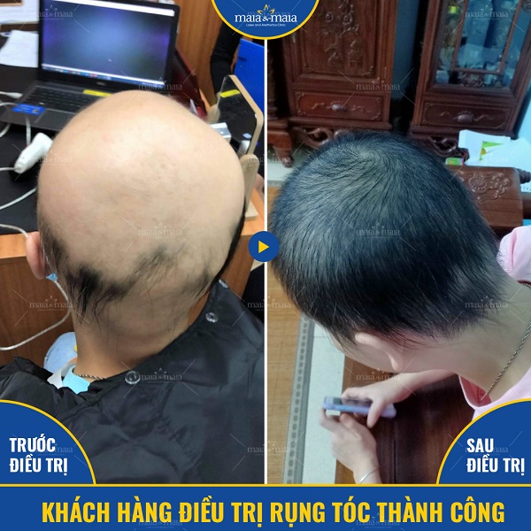 Những lý do gây ra bệnh rụng tóc ở thanh thiếu niên 5 Khách hàng điều trị rụng tóc thành công tại phòng khám Maia