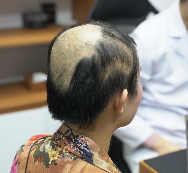 Những lý do gây ra bệnh rụng tóc ở thanh thiếu niên 4 Rụng tóc do nấm da đầu