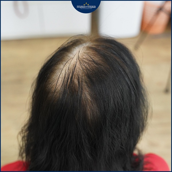 Giải pháp cho chứng rụng tóc do mãn kinh ở phụ nữ 1 Chứng rụng tóc do mãn kinh làm thưa hói tóc ở vùng đỉnh đầu
