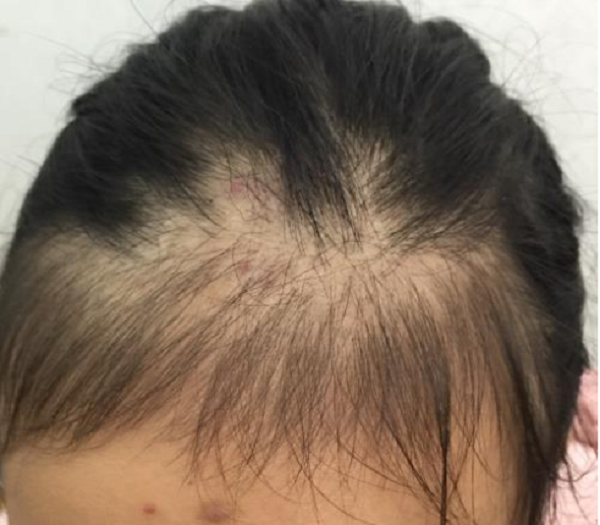 Những lý do gây ra bệnh rụng tóc ở thanh thiếu niên 1 Bạn có thể nhận biết tình trạng rụng tóc ở thanh thiếu niên bằng mắt thường