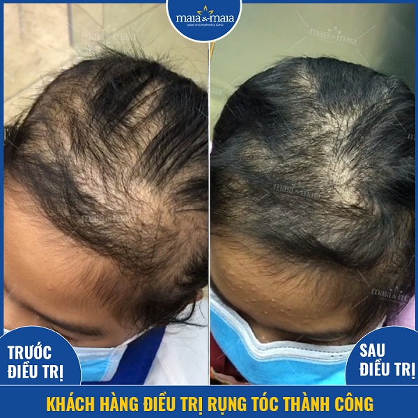 Những lý do gây ra bệnh rụng tóc ở thanh thiếu niên 3 Tóc rụng loang lỗ và yếu