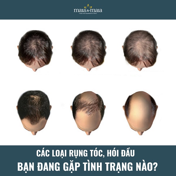 Những mẹo chăm sóc tóc cho nam giới bạn nên biết 4 Nếu không chăm sóc tốt, tóc dễ bị rụng và hói đầu