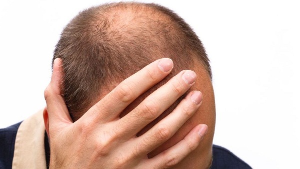 Rụng tóc ở đỉnh đầu nam giới - Nguyên nhân và hướng khắc phục (Phần 1) 2 Hầu hết những người xạ trị đều bị rụng tóc