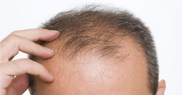 Có hay không tình trạng rụng tóc do thuốc lá - Cách khắc phục là gì? 1 Hút thuốc lá có thể kích phát quá trình rụng tóc hói đầu ở nam giới