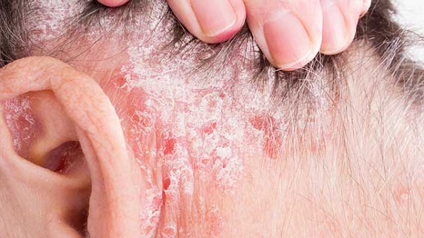 Rụng tóc do viêm da đầu: Nguyên nhân & cách điều trị 2 Viêm da tiết bã có biểu hiện bệnh khá tương tự như vảy nến và nấm đầu