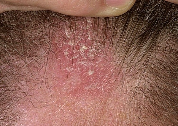 Rụng tóc sẹo là gì? Có thể ngăn ngừa bằng cách nào? 4 Viêm da trên đầu gây rụng tóc sẹo