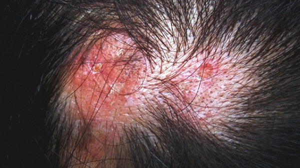 Rụng tóc sẹo là gì? Có thể ngăn ngừa bằng cách nào? 1 Rụng tóc sẹo do lupus ban đỏ dạng đĩa