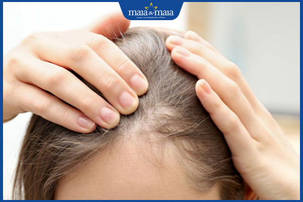 tình trạng rụng tóc tự miễn