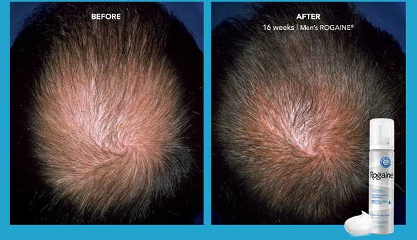Điều trị rụng tóc bằng Rogaine có hiệu quả không? 2 Rogaine kích thích tóc mọc lên dày dặn