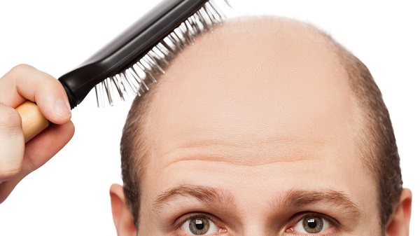Điều trị rụng tóc bằng Rogaine có hiệu quả không? 3 Những người đã bị hói nặng thì không nên sử dụng Rogaine