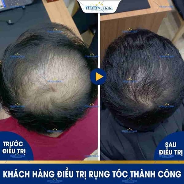 Rụng tóc do DHT là gì? Có khắc phục được không? 7 rụng tóc do DHT