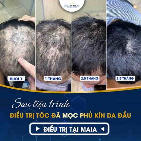Rụng tóc do DHT là gì? Có khắc phục được không? 9 rụng tóc do DHT