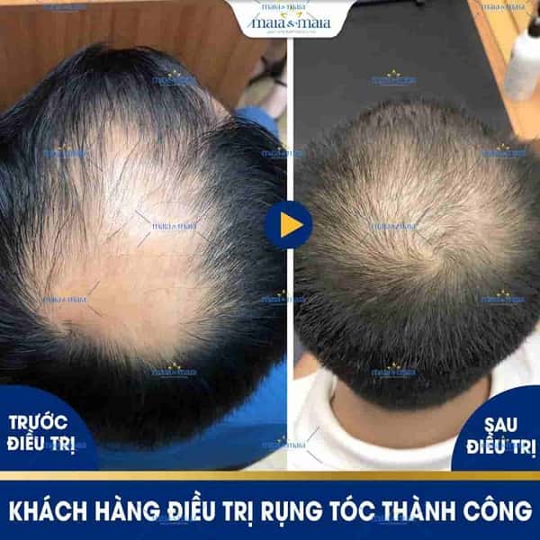 Rụng tóc do DHT là gì? Có khắc phục được không? 2 rụng tóc do DHT
