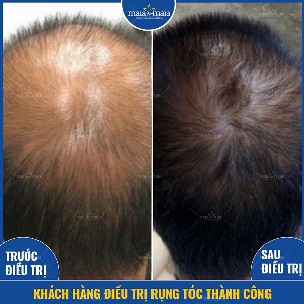 Rụng tóc do DHT là gì? Có khắc phục được không? 10 Điều trị rụng tóc bằng phương pháp cung cấp dưỡng chất tại phòng khám Maia
