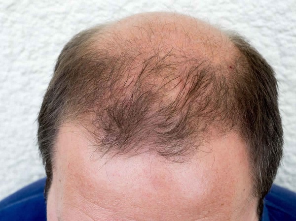 Rụng tóc do nội tiết là như thế nào? 2 Kiểu rụng tóc hói đầu phổ biến do androgen