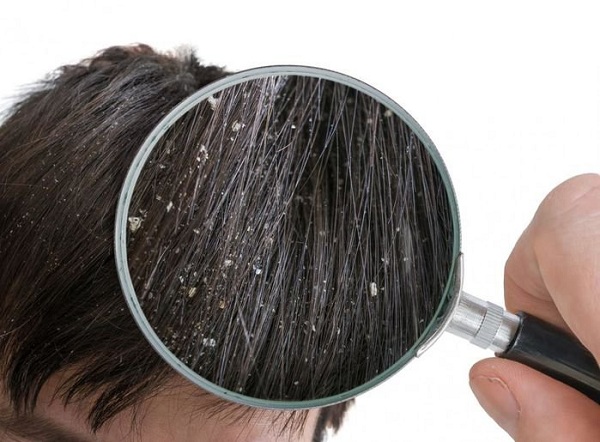 Ngứa da đầu kèm theo rụng tóc - Nguyên nhân do đâu? 1 Các vảy gàu là biểu hiện hiện thường đi kèm với ngứa da đầu