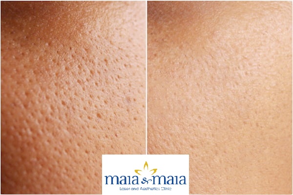 Thu nhỏ lỗ chân lông to bằng laser tại phòng khám Maia