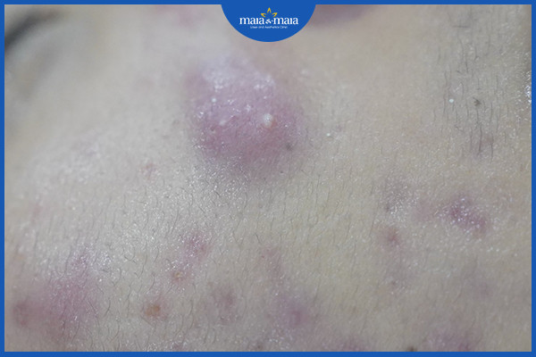 Mụn nang là gì? Những cách điều trị mụn nang 2 Mụn nang thường gây sưng và đau