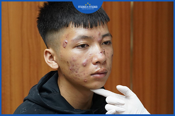Mụn nang là gì? Những cách điều trị mụn nang 3 Không điều trị mụn nang đúng cách có thể gây tổn thương nặng nề trên da