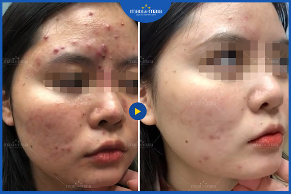 Mụn nội tiết là gì? Làm cách nào để loại bỏ mụn nội tiết? 6 Hiệu quả sau khi điều trị mụn tại phòng khám Maia