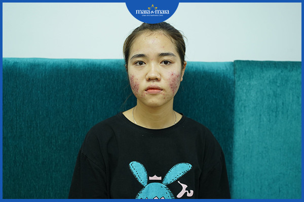 Mụn nội tiết là gì? Làm cách nào để loại bỏ mụn nội tiết? 2 Nội tiết là một trong những nguyên nhân gây ra tình trạng mụn trứng cá