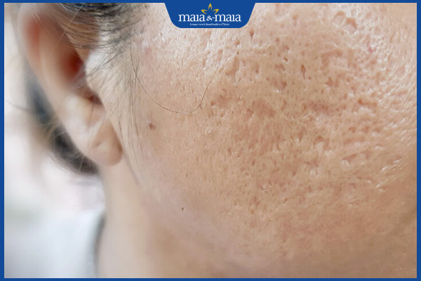 mụn trứng cá gây sẹo trên da