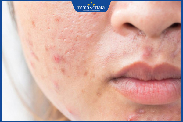 mụn trứng cá viêm gây sẹo