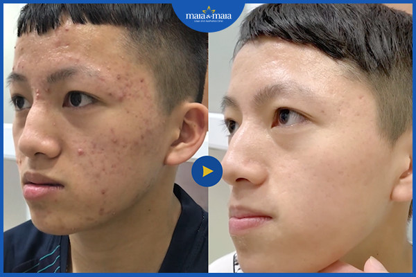 Cách ngăn mụn tái phát để duy trì làn da khỏe mạnh 6 Cần thăm khám với bác sĩ da liễu để được tư vấn điều trị mụn đúng cách