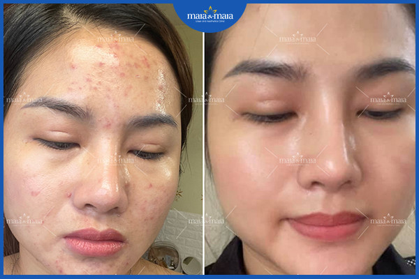 Cách ngăn mụn tái phát để duy trì làn da khỏe mạnh 2 Cần kiểm soát tốt các yếu tố gây mụn để ngăn mụn tái phát
