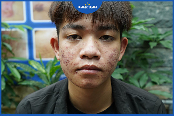 Cách ngăn mụn tái phát để duy trì làn da khỏe mạnh 3 Cần kết hợp điều trị mụn và chăm sóc da để duy trì hiệu quả
