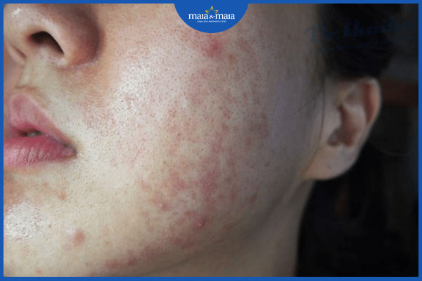 4 Sai lầm trong chăm sóc da mụn mà bạn có thể đang mắc phải 5 Tăng sắc tố sau khi hết mụn trứng cá