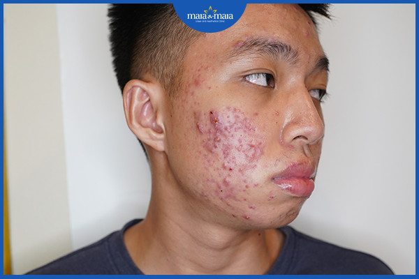 4 Sai lầm trong chăm sóc da mụn mà bạn có thể đang mắc phải 3 Cạy mụn có thể khiến mụn trở nên nghiêm trọng hơn