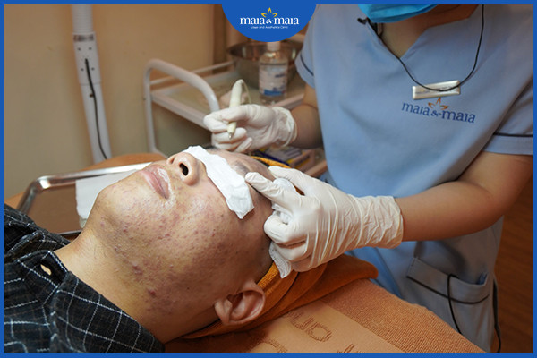 4 Sai lầm trong chăm sóc da mụn mà bạn có thể đang mắc phải 2 Bạn nên nặn mụn tại theo phương pháp chuẩn y khoa