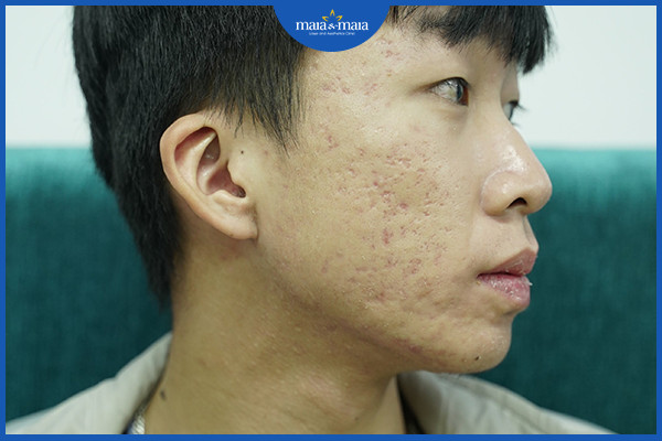 4 Sai lầm trong chăm sóc da mụn mà bạn có thể đang mắc phải 6 Sẹo rỗ là một trong những hậu quả do trị mụn trứng cá không đúng cách