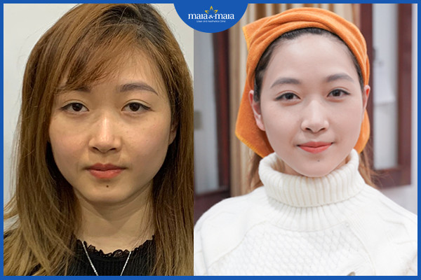 Cải thiện các dấu hiệu lão hóa bằng công nghệ Utherapy