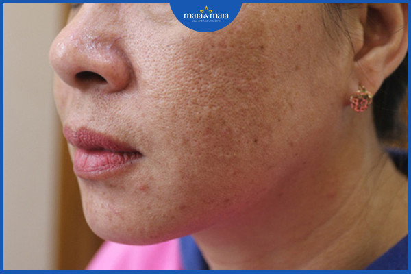 Da nám và sần sùi - những dấu hiệu của lão hóa da